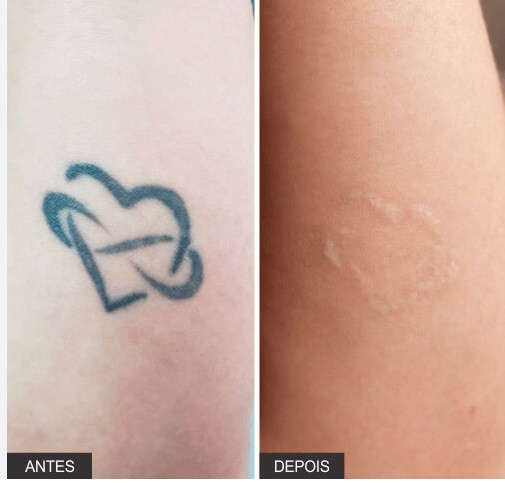 REMOÇAO DE TATUAGEM